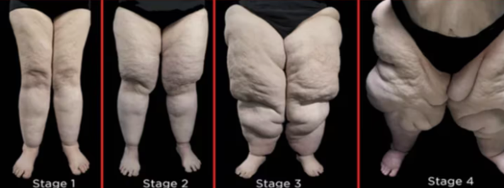 Dyslipidemia EXPLOSION